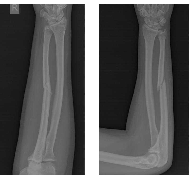 Смещение лучевой кости фото. Перелом локтевой кости рентген. Перелом диафиза локтевой кости. Перелом средней трети диафиза локтевой кости. Изолированные переломы диафиза локтевой кости.