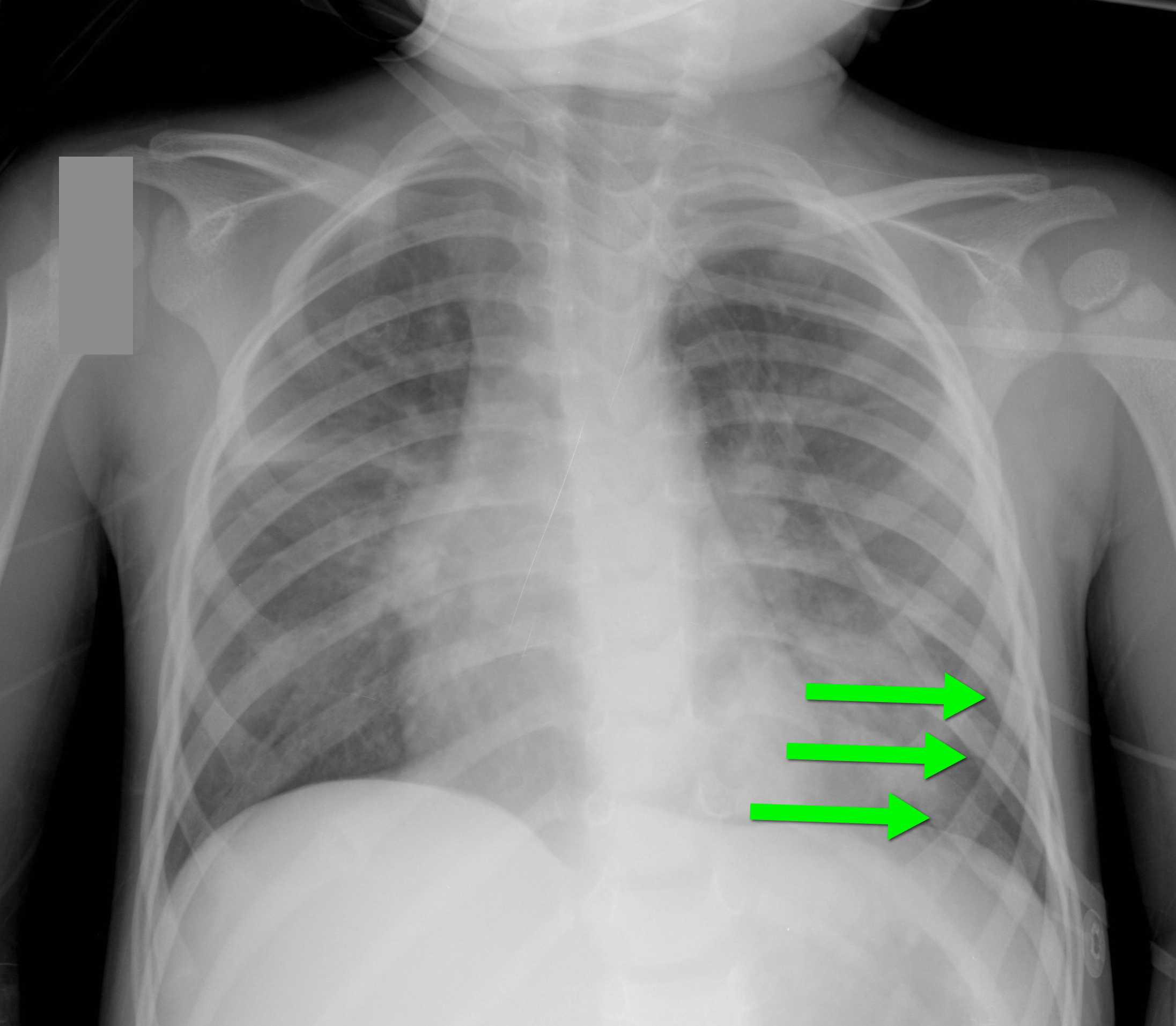 Трещины на грудном. Перелом грудной клетки рентген. Рентген перелом ребра слева. Сращение ребер рентген.