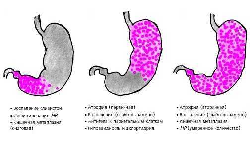 Лечение атрофии слизистой желудка препараты схема