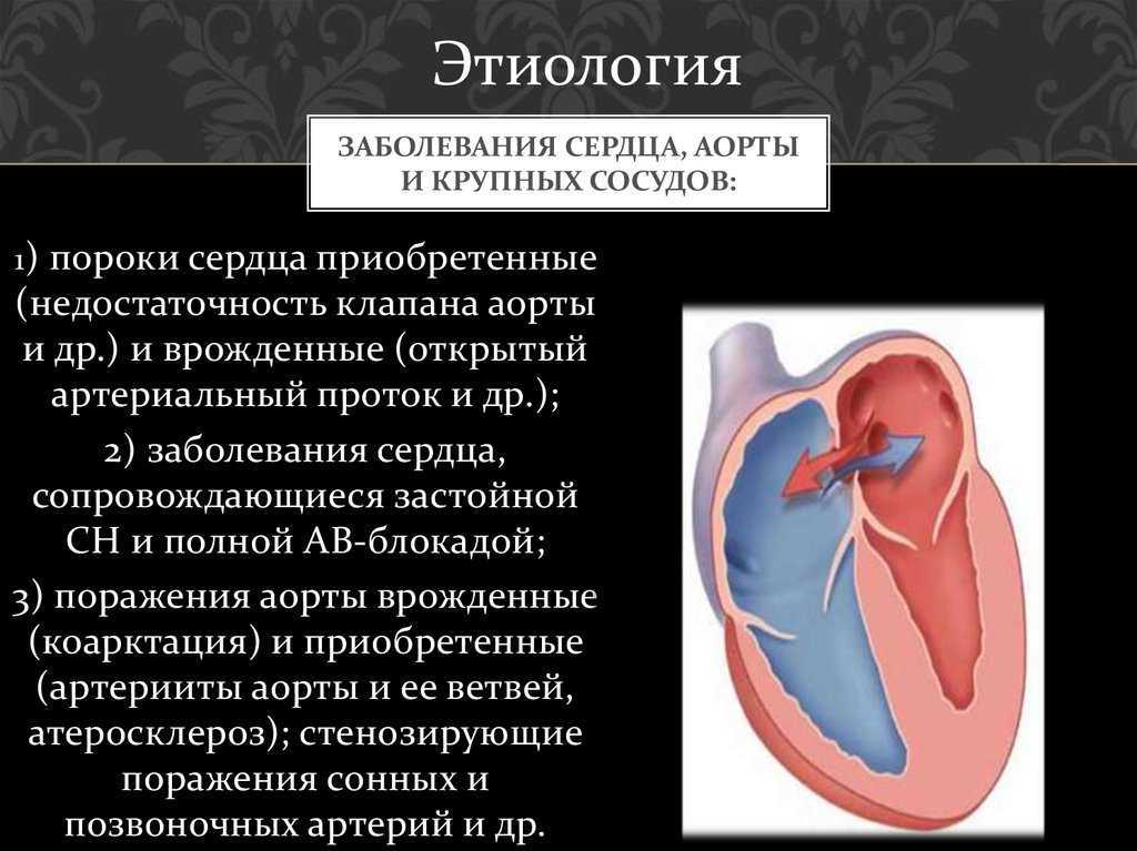Преимущественное поражение сердца без застойной сердечной. Заболевания сердца приобретенный порок. Аортальный стеноз клиника. Клиника порока сердца недостаточность аортального клапана. Пороки сердца этиология.