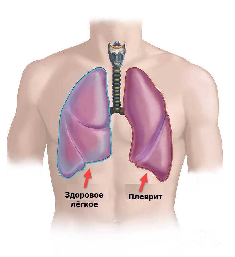 Плевральная полость картинки