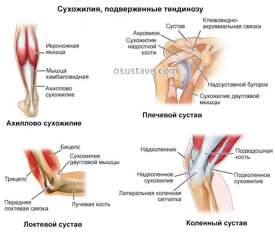 Лечение частичного разрыва мышц. Тендинит коленного сухожилия. Воспаление сухожилия надколенника симптомы. Тендинит связки надколенника. Строение колена связки и мышцы.