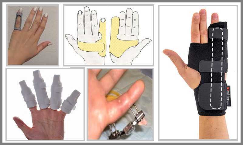 Разработать пальцы после. Бандаж для пястно-фалангового сустава Крейт е-207. Ортез при переломе 5 пястной кости. Шина на руку при переломе Мезинц.