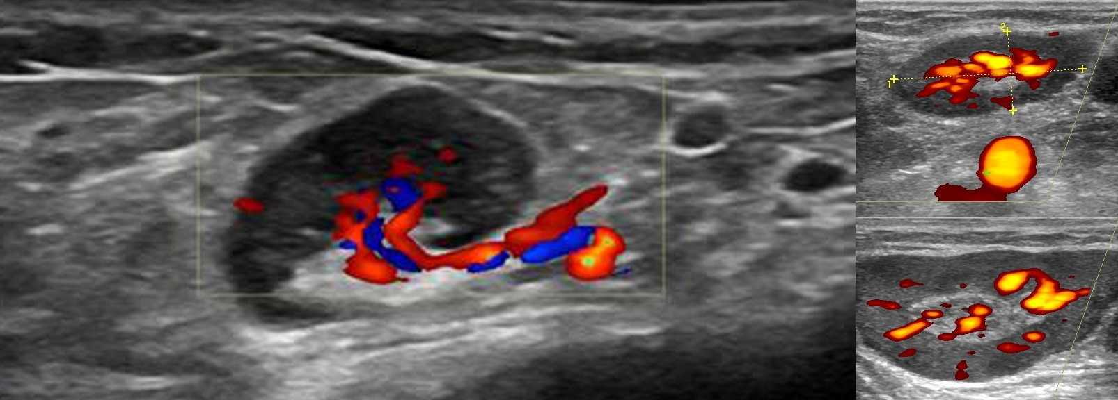 Конгломерат узлов. Лимфатический узел эхограмма. Лимфома щитовидной железы УЗИ УЗИ. УЗИ лимфоузлы кровоток. Паховый лимфаденит на УЗИ.