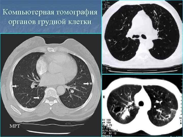 Тяжелая миастения: общая характеристика и сопутствующие патологии. часть 1 | университетская клиника