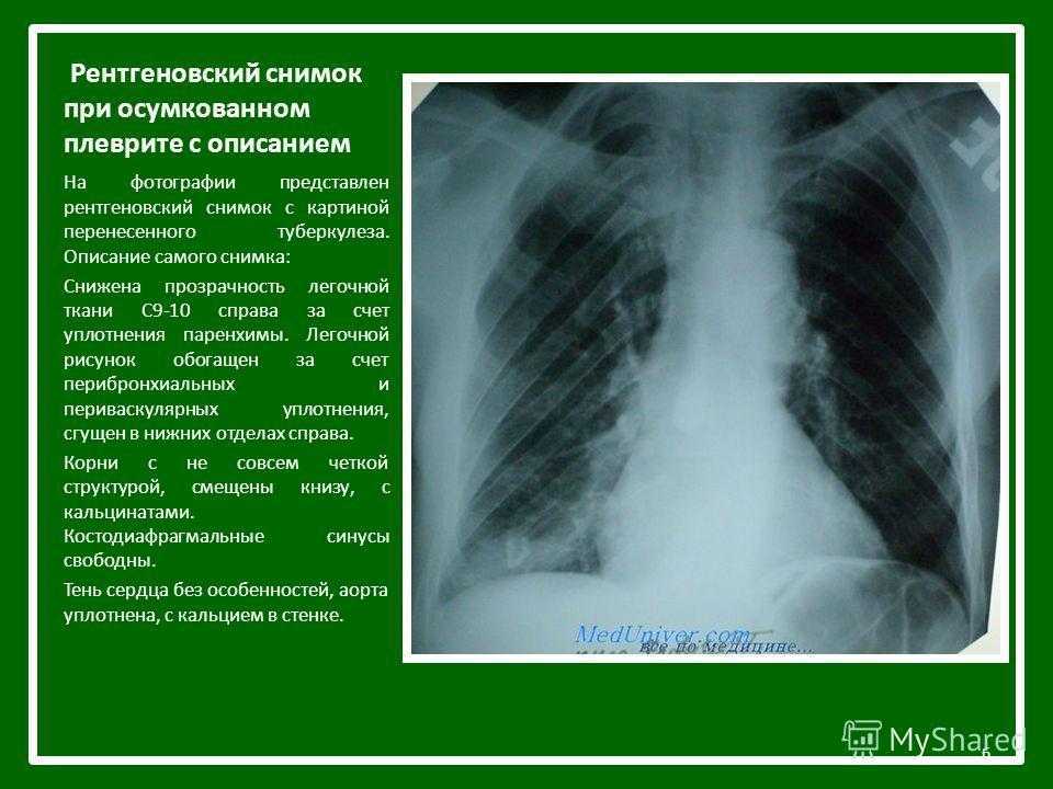 Диагностика туберкулеза легких методом малодозовой цифровой рентгенографии (продолжение)