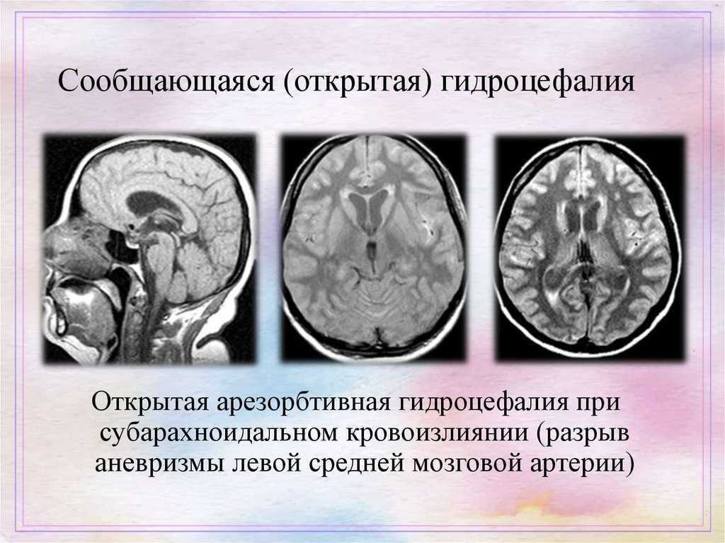 Мр картина смешанной заместительной гидроцефалии