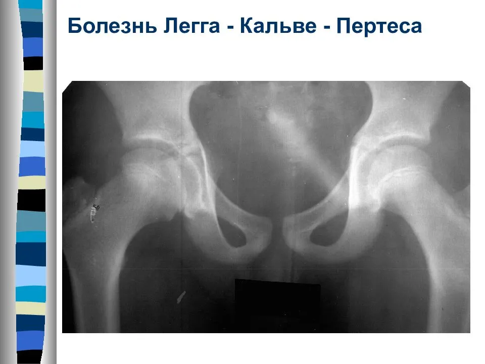 Остеохондропатия