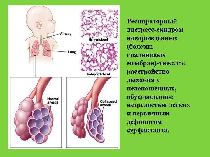 Респираторный дистресс синдром новорожденных презентация