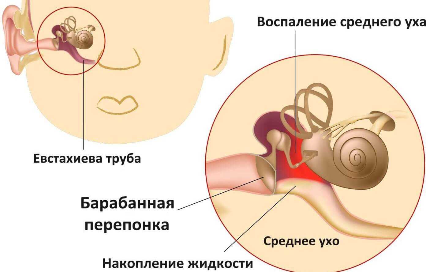 Как понять что у ребенка болят уши. Средний отит барабанная перепонка. Воспаление среднего уха. Восполениеисреднего уха.