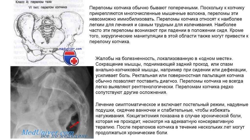 Перелом копчика карта вызова