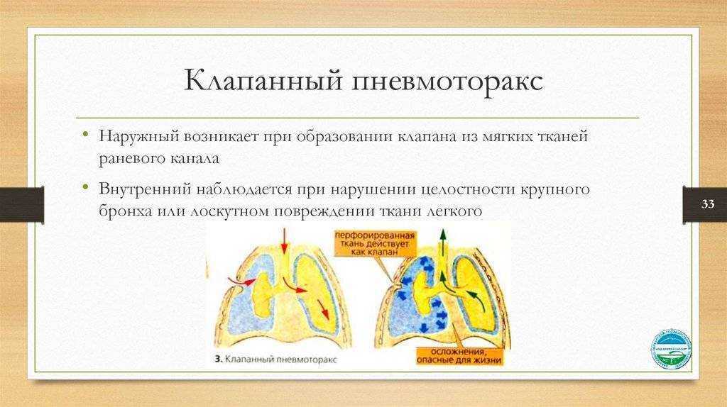 Клапанный пневмоторакс презентация