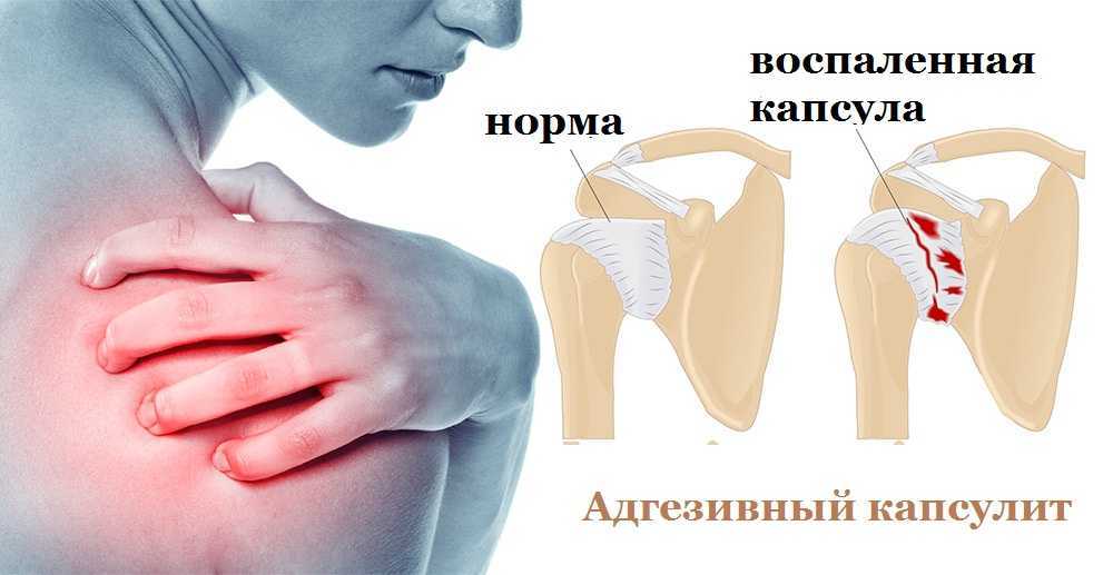 Плече-лопаточный периартрит