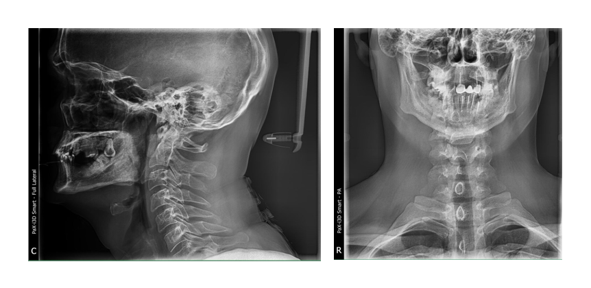 Рентген шейного отдела фото