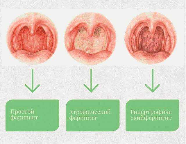 Схема лечения фарингита