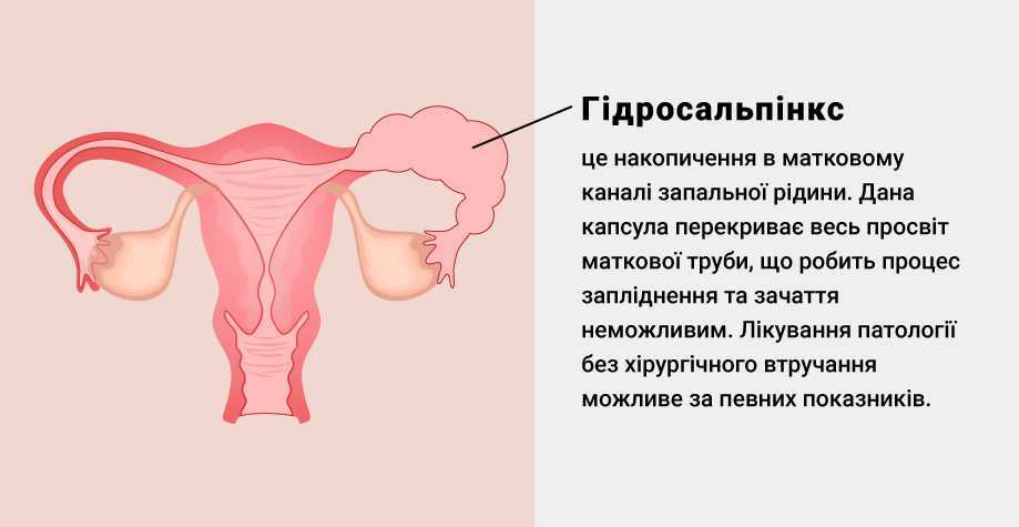 Схема лечения гидросальпинкса