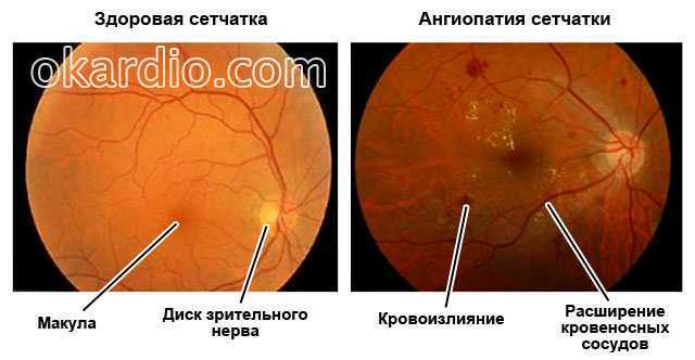 Ангиопатия сосудов сетчатки что это. Гипертоническая ангиопатия и ретинопатия. Гипертоническая ретинопатия глазное дно. Ангиопатия сетчатки глазное дно. Ангиопатия сосудов глазного дна.