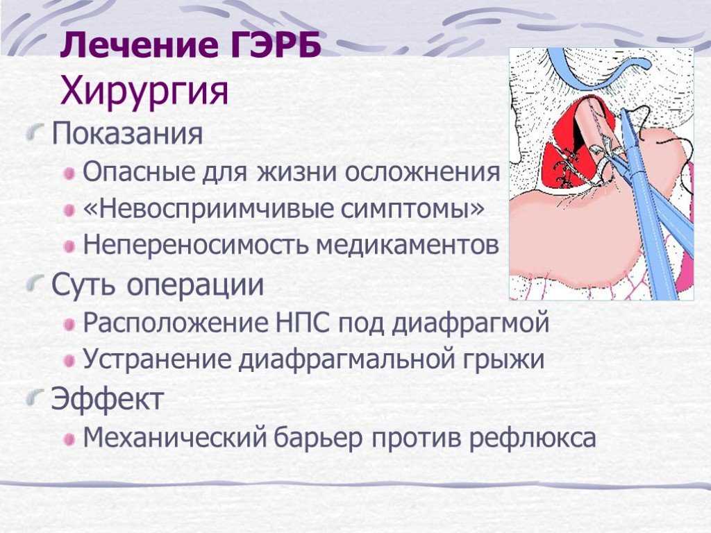 Как облегчить состояние при кишечной метаплазии