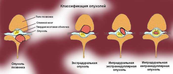 Опухоли спинного мозга презентация