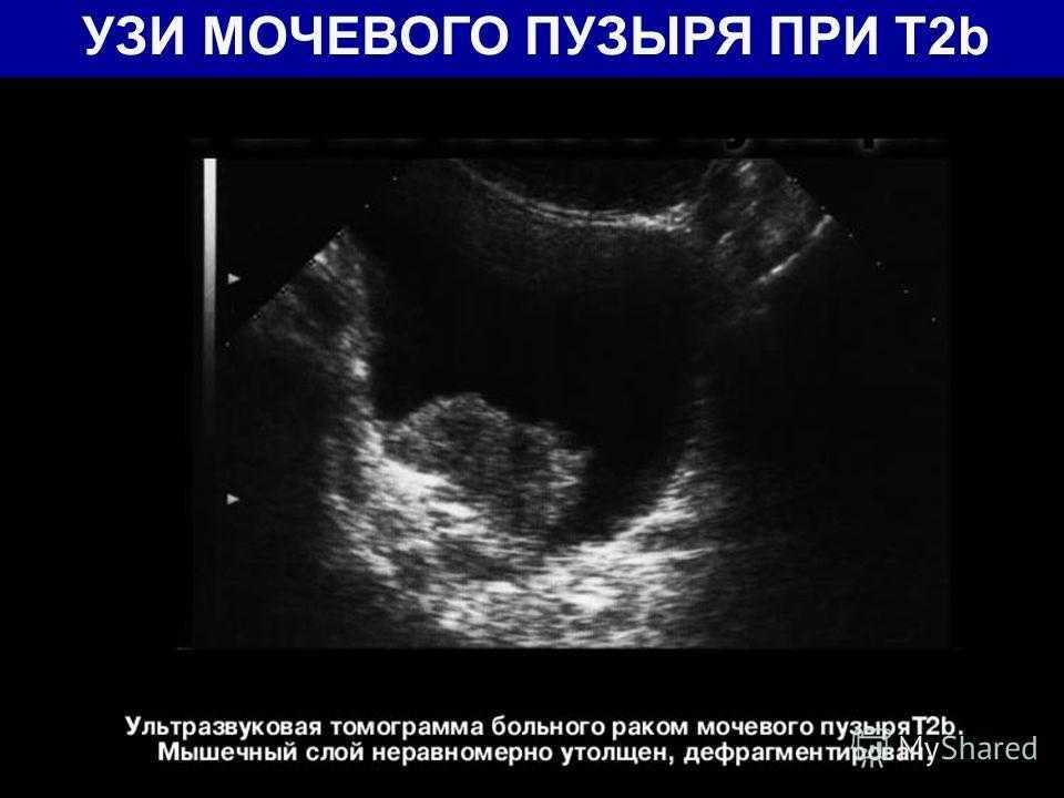 Катетеризация мочевого пузыря у женщин, мужчин: алгоритм и техника введения
