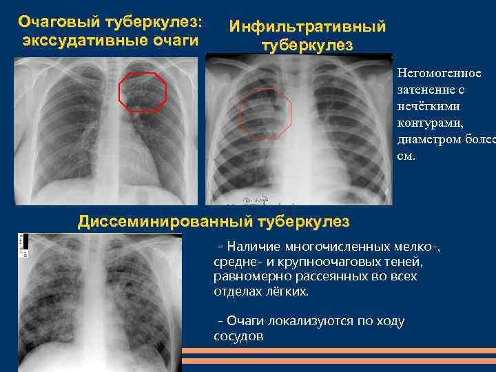 Современные методы обследования в дифференциальной диагностике туберкулеза