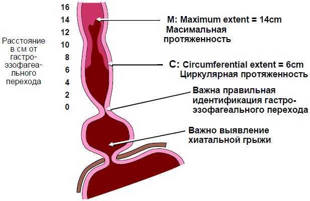 Рефлюкс эзофагит - причины, симптомы, современная диагностика и эффективное лечение :: polismed.com