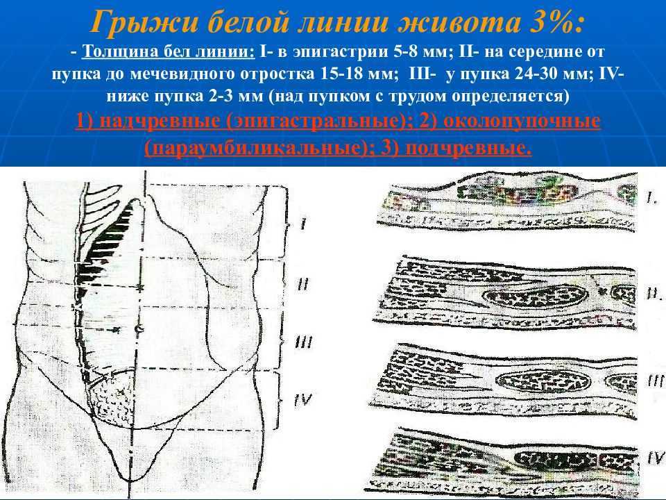 Грыжа белой линии живота на узи фото описание