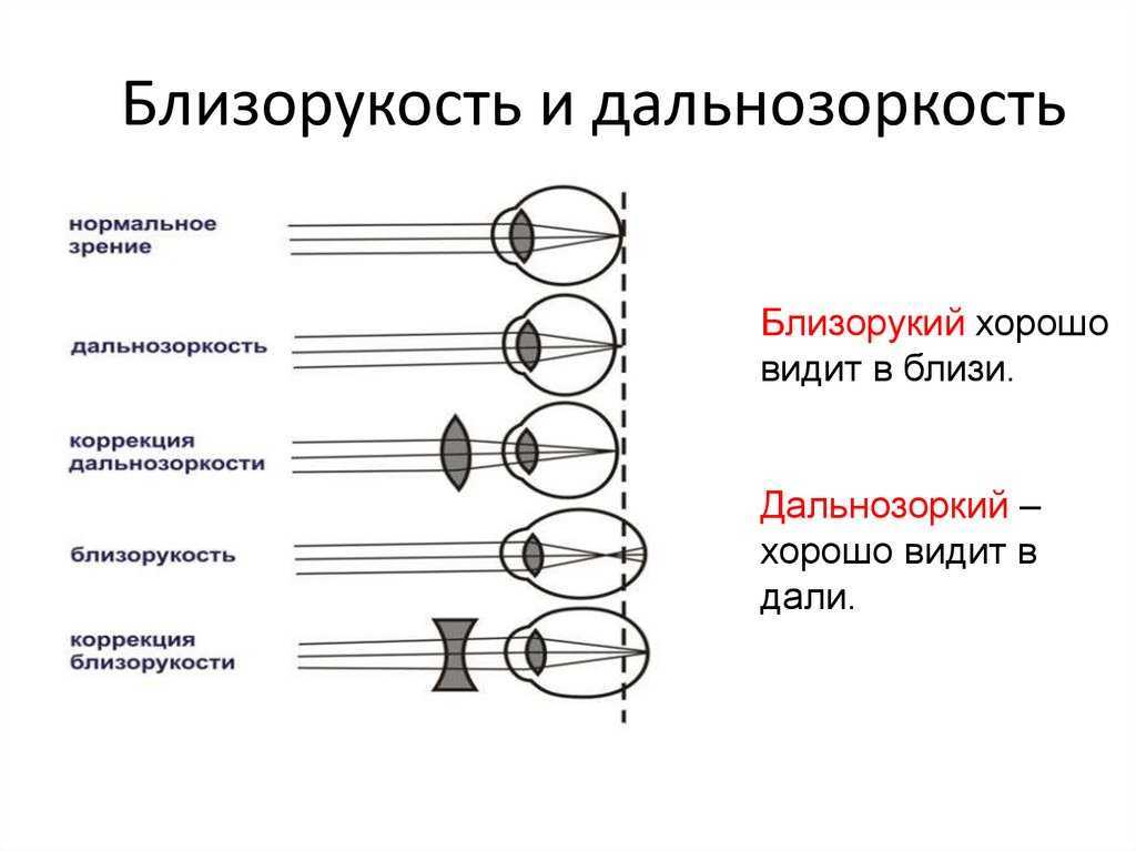 Рефракционная близорукость: причины, симптомы, лечение - энциклопедия ochkov.net