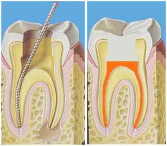 Боль в челюсти после удаления нерва зуба