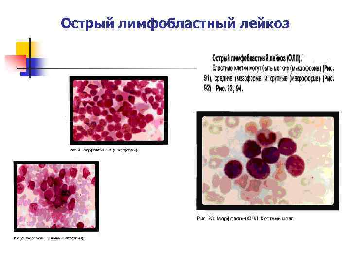 Лимфобластный лейкоз прогноз