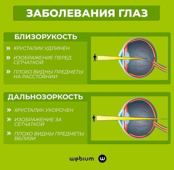 Какое зрение при дальнозоркости. Дальнозоркость и близорукость строение глаза. Что такое близорукость (миопия) и дальнозоркость (гиперметропия). Таблица заболевания глаз близорукость и дальнозоркость. Близорукость форма хрусталика.