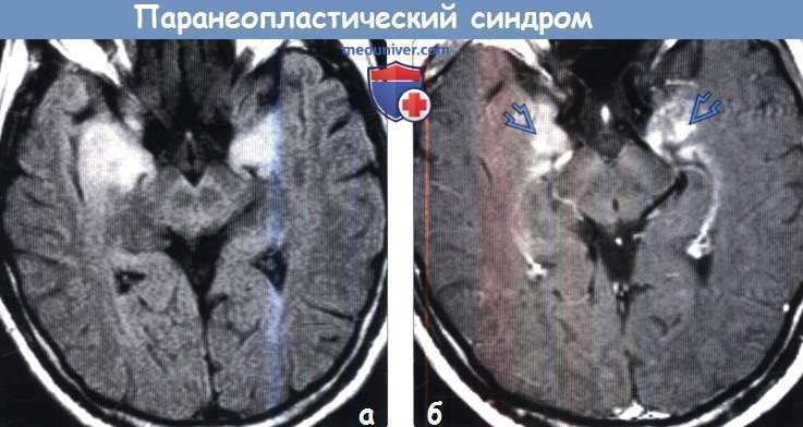 Множественный эндокринный неопластический синдром, или мэн i типа множественный эндокринный аденоматоз i типа, синдром вермера, представляет собой