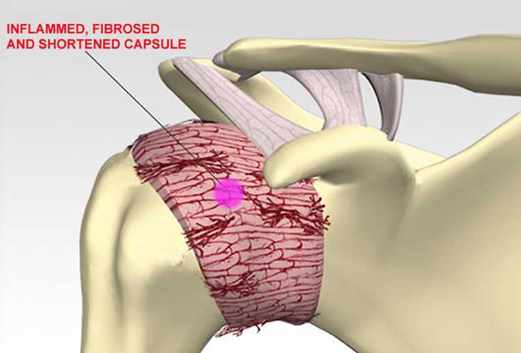 Капсула плечевого сустава фото