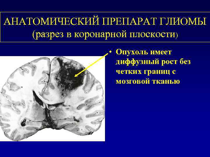 Глиома опухоль. Опухоль мостомозжечкового угла. Опухоль среднего мозга. Диффузного объемного образования головного мозга.