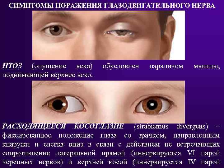 Как распознать миастению? все о диагностике и лечении