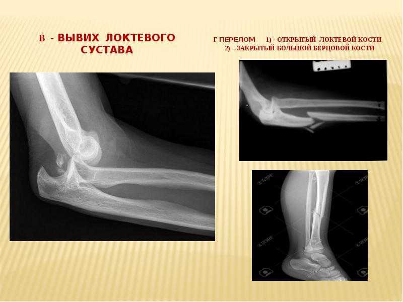 Лечение вывихов, растяжений, разрывов связок
