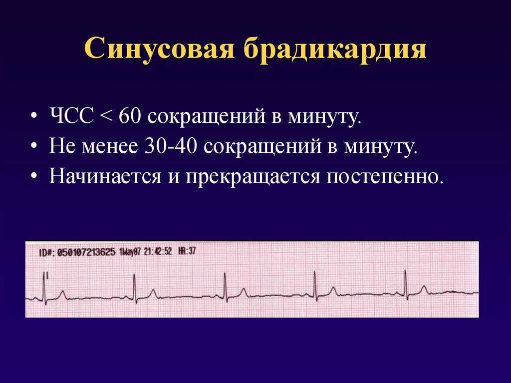 Брадикардия сердца – причины, симптомы и лечение в фнкц фмба россии