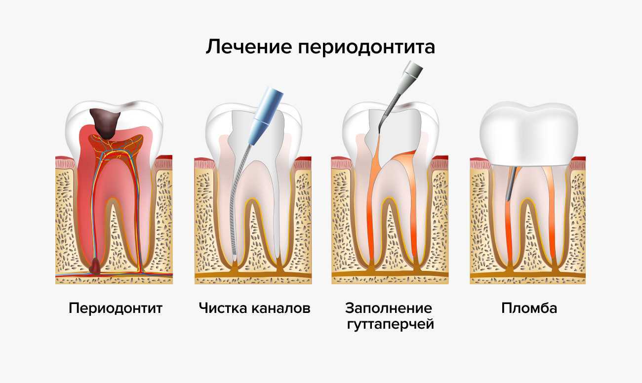 Боль после удаления зуба: сколько держится