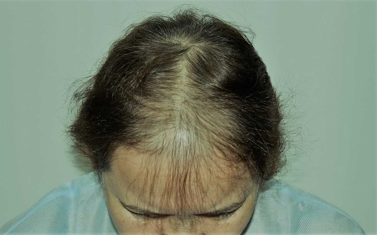 11 лет выпадают волосы. Андрогенетическая алопеция. Андрогенная алопеция алопеция. Гиперандрогенная алопеция. Очаговая (гнездная) алопеция.