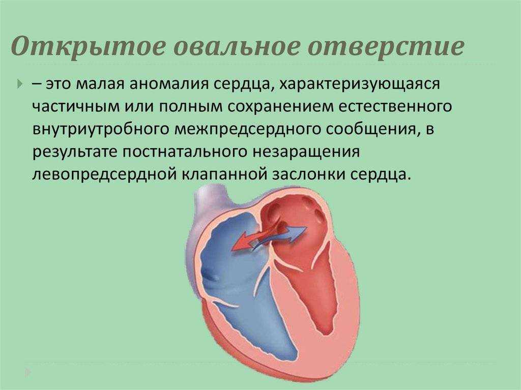 Открытое овальное окно в сердце у детей и взрослых - понятие, причины незакрытия, течение и тактика лечения
