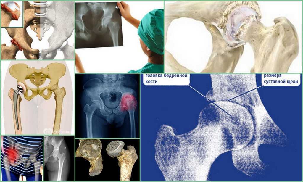 Эндопротез тазобедренного сустава ortoped-klinik.com