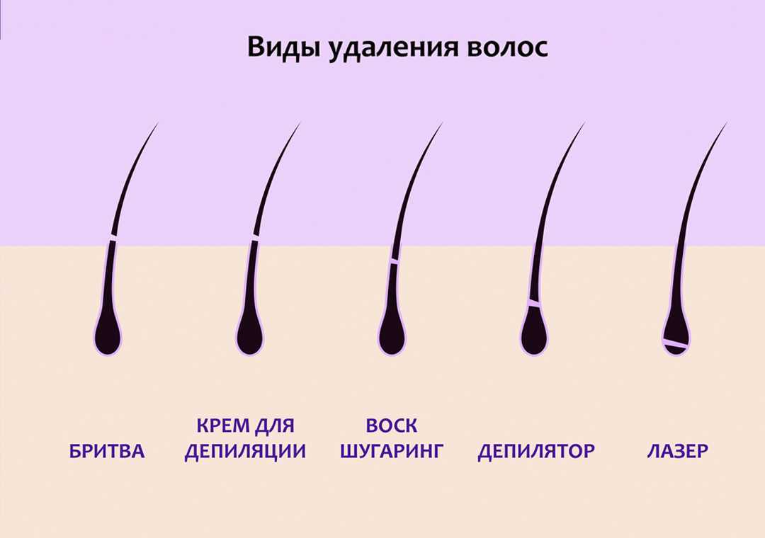 При шугаринге волосы удаляются по росту волос