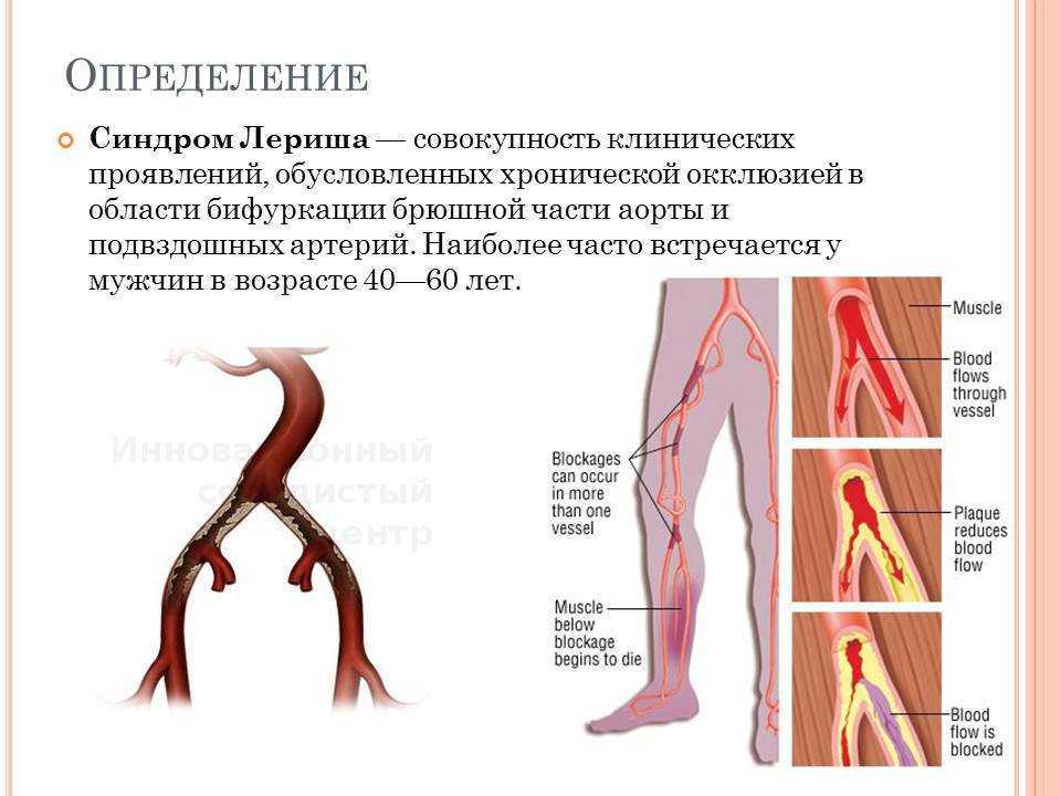 Тромбоз артерий