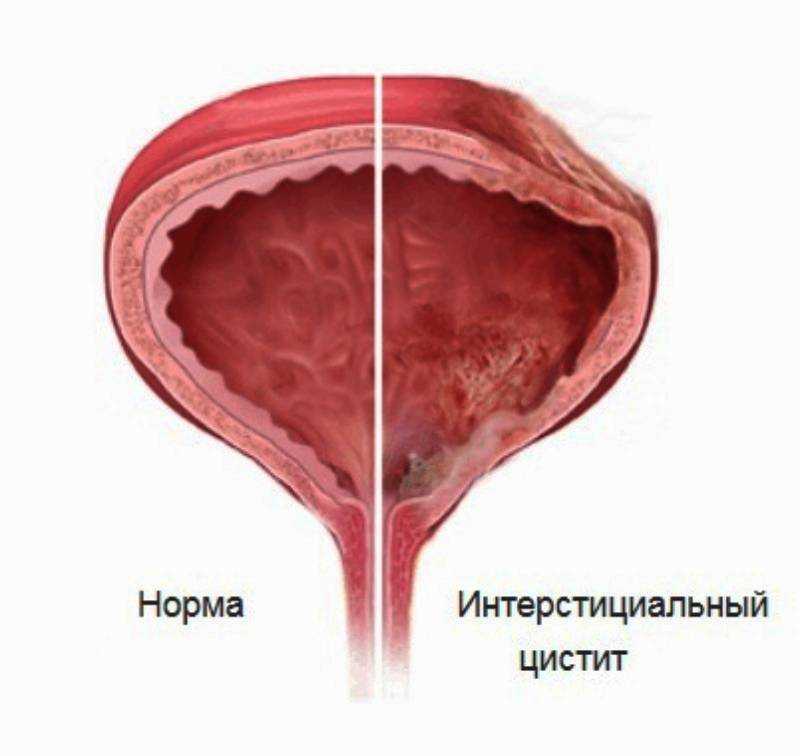 Симптомы мочевого пузыря у мужчин признаки. Хронический цистит гистология. Хронический интерстициальный цистит. Интерстициальная ткань мочевого пузыря. Интерстициальный цистит цистоскопия.