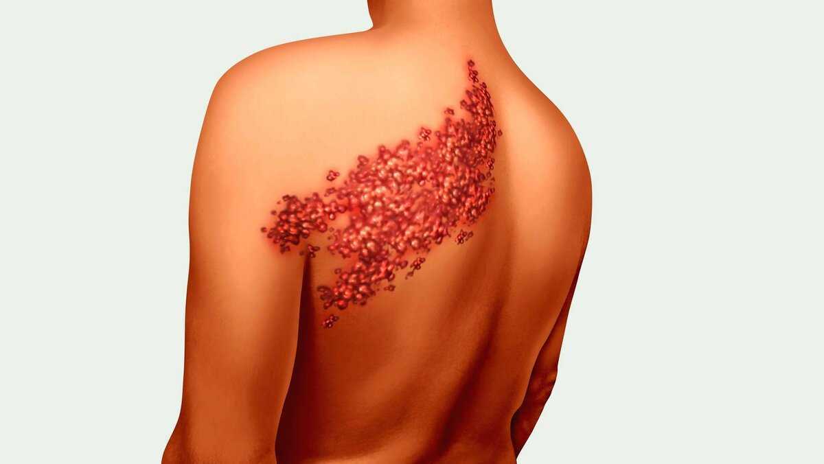 кожные заболевания на груди у женщин фото 73