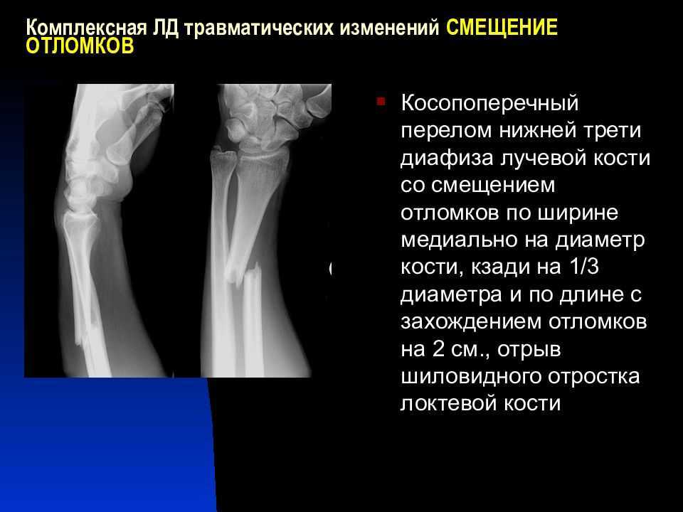 Перелом локтевой кости со смещением операция. Переломы лучевой кости классификация. Переломы локтевой кости классификация. Без костно травматических изменений. Косопоперечный перелом.