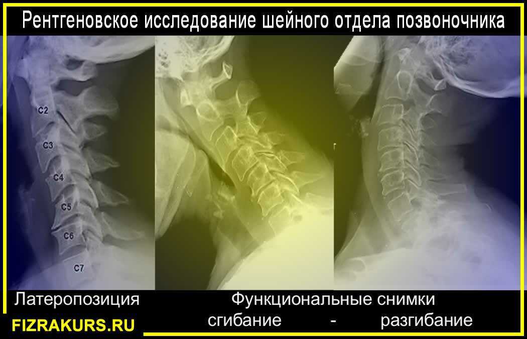 Эхографическая картина нестабильности в сегменте с2 с3