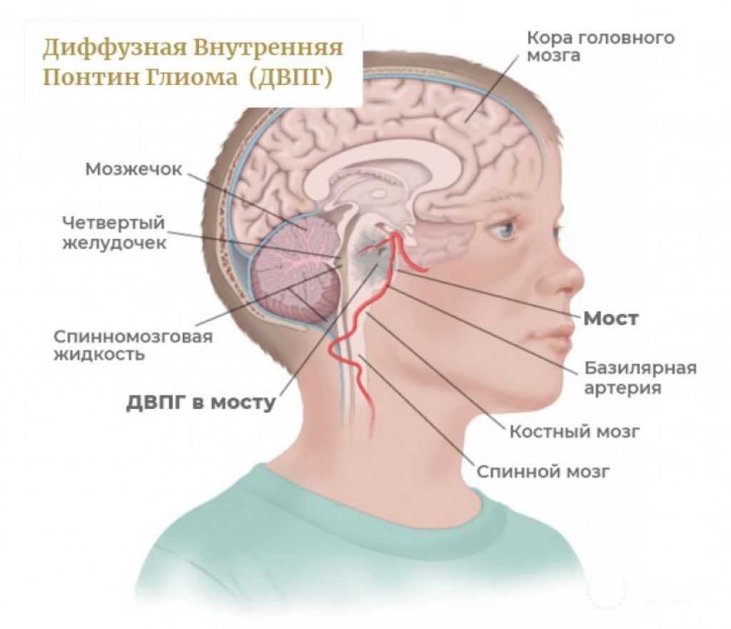 Проблемы с головным мозгом симптомы. Глиома ствола головного мозга симптомы. Опухоль ствола головного мозга у детей. Опухоль 4 желудочка головного мозга симптомы. Глиома опухоль головного мозга симптомы.