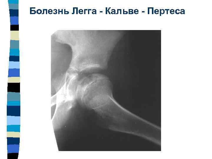 Остеопороз
