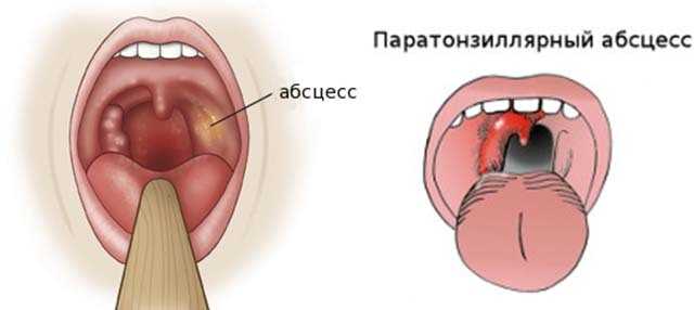 Карта вызова смп острый тонзиллит у взрослого